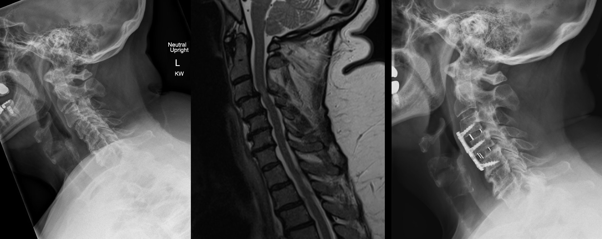 Cervical Fusion MODERN SPINE   Cervfusion 