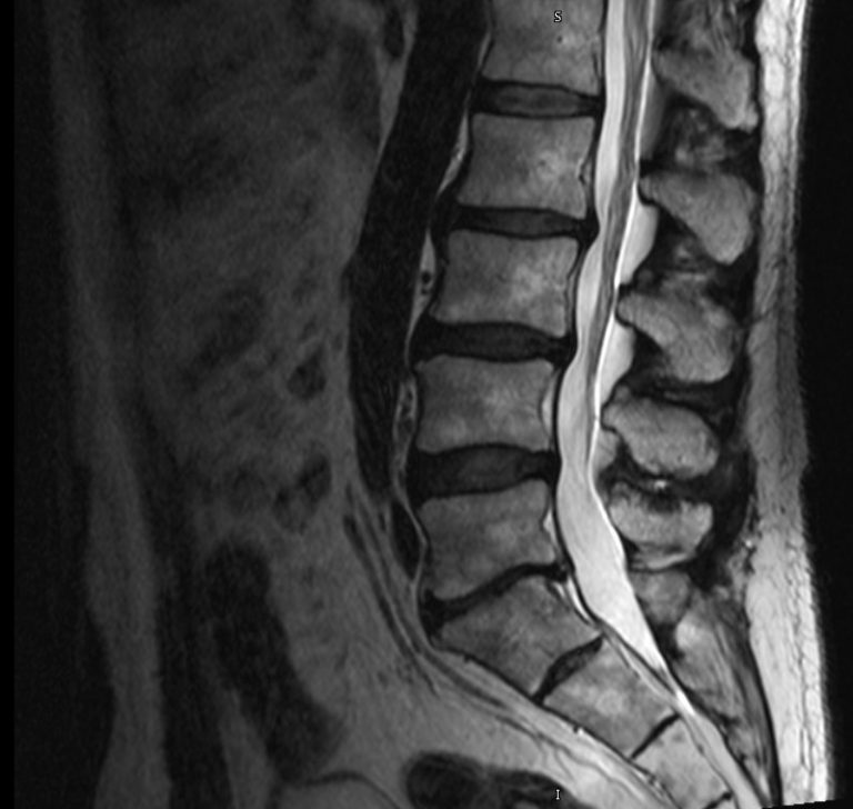 Lumbar Disc Replacement MODERN SPINE