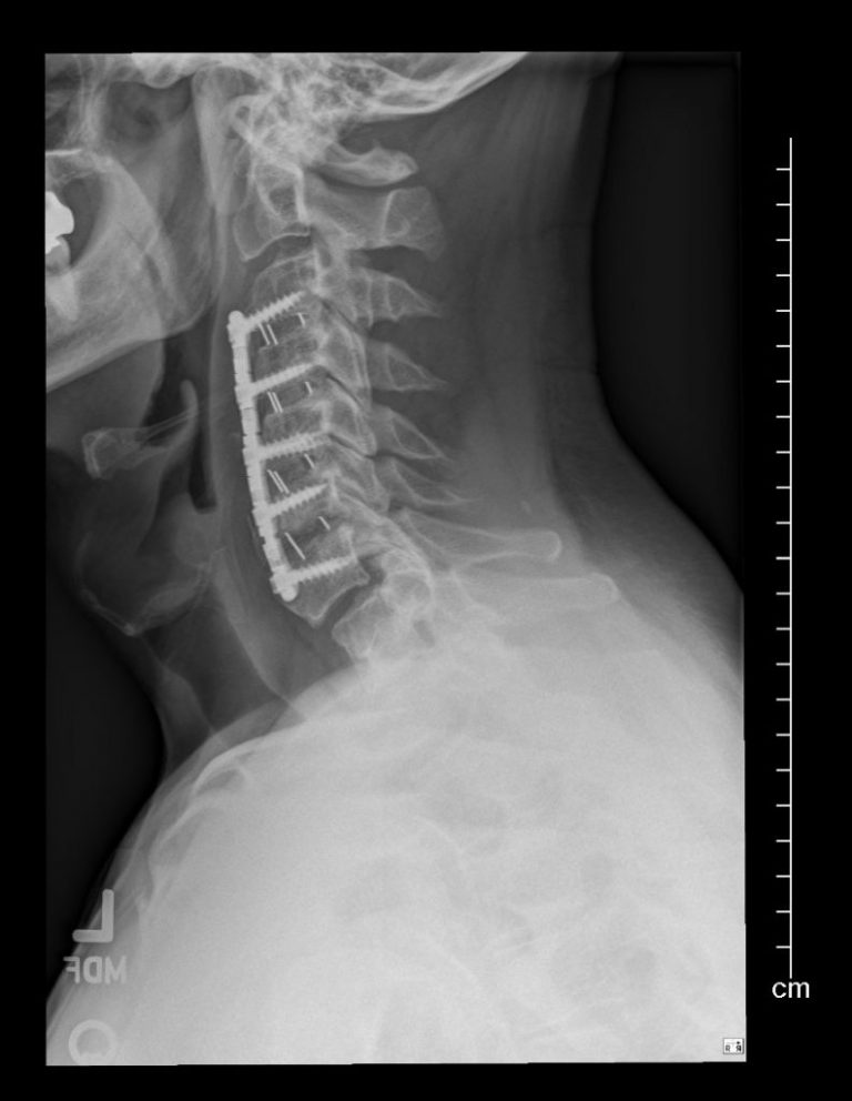 Minimally Invasive Neck Surgery – MODERN SPINE